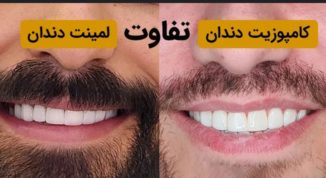 کامپوزیت چیست و چه تفاوتی با لمینت دندان دارد