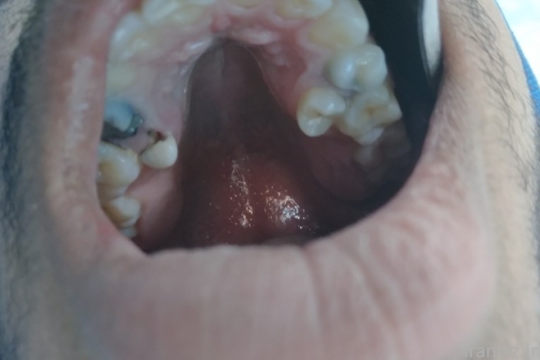 جراحی دندان عقل جراحی ایمپلنت 