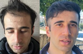 بهترین کاشت مو شهریار 