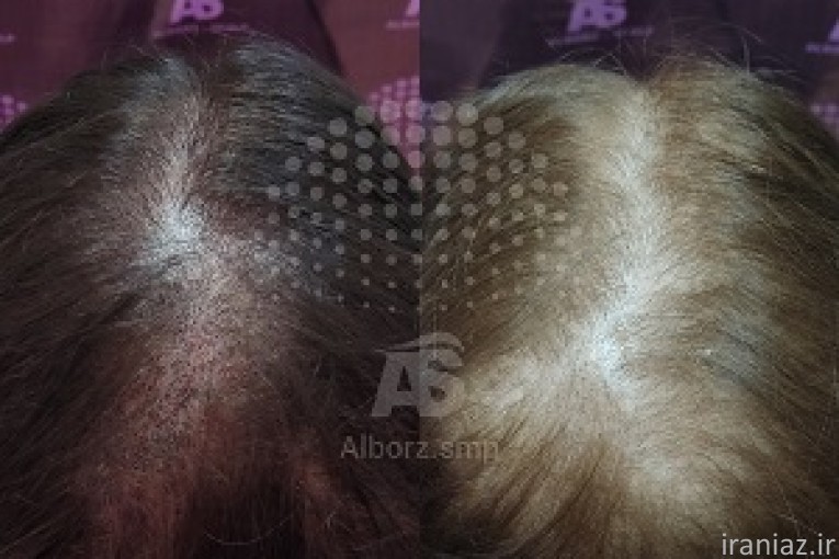 میکرواسکالپ سر در کرج