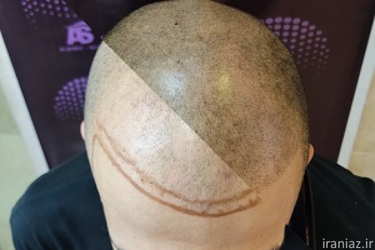 میکرواسکالپ سر در کرج