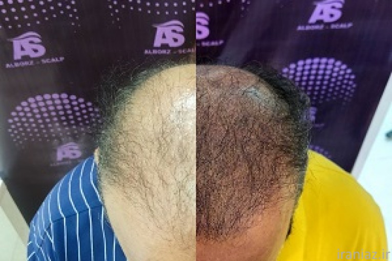 میکرواسکالپ سر در کرج