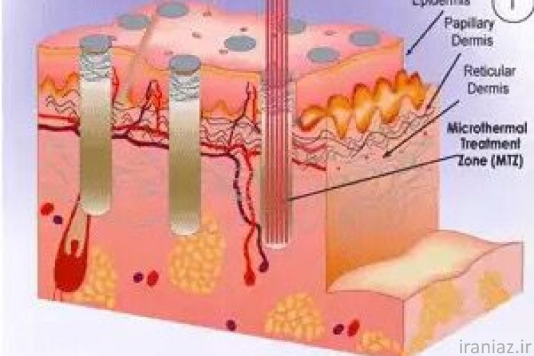 قیمت دستگاه لیزر CO2 فرکشنال