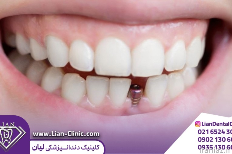  ایمپلنت اقساطی در شهریار 