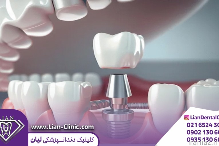  ایمپلنت اقساطی در شهریار 