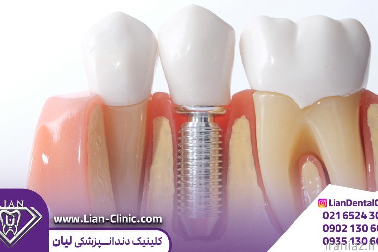  ایمپلنت اقساطی در شهریار 