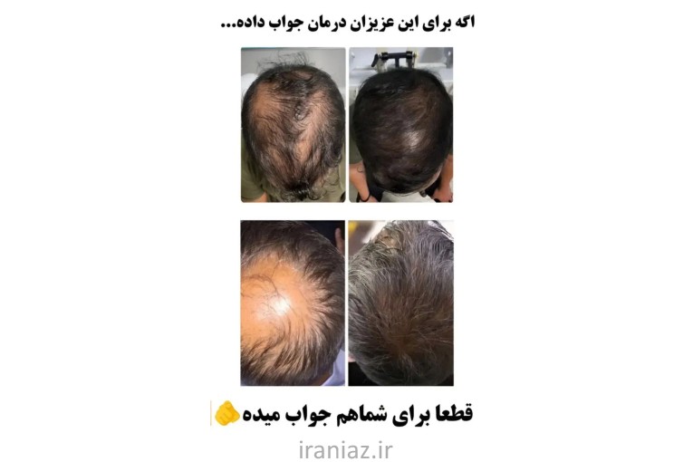 درمان ریزش مو قطعی 