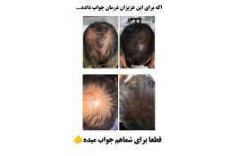 درمان ریزش مو قطعی 
