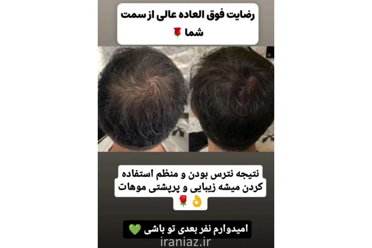 درمان ریزش مو قطعی 