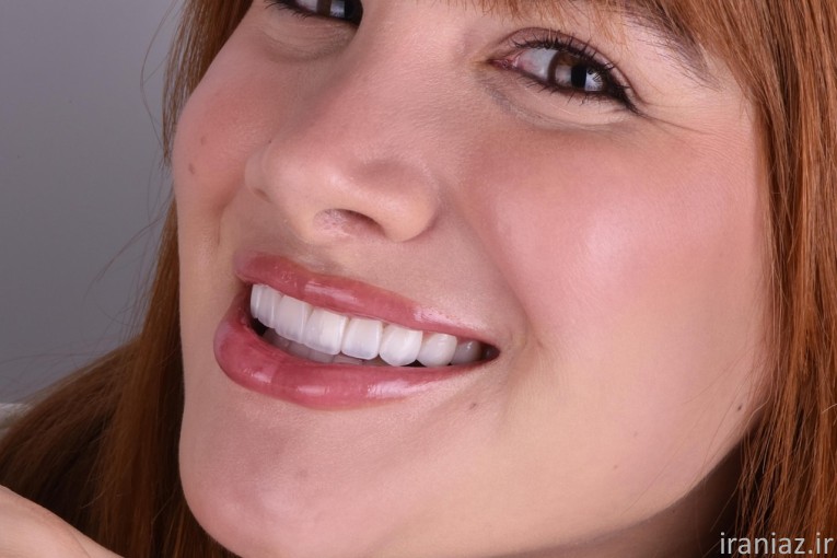 کامپوزیت لمینیت ایمپلنت دندانپزشکی 