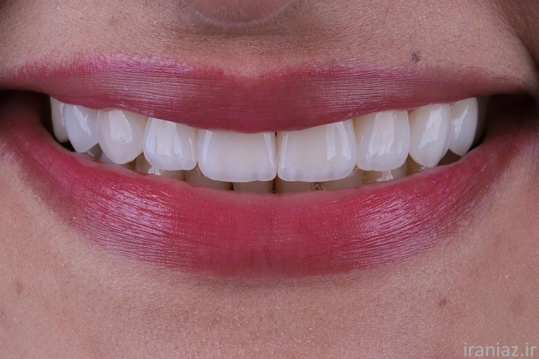 کامپوزیت لمینیت ایمپلنت دندانپزشکی 