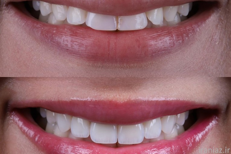 کامپوزیت لمینیت ایمپلنت دندانپزشکی 