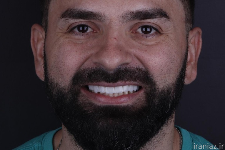 کامپوزیت لمینیت ایمپلنت دندانپزشکی 