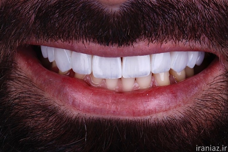 کامپوزیت لمینیت ایمپلنت دندانپزشکی 