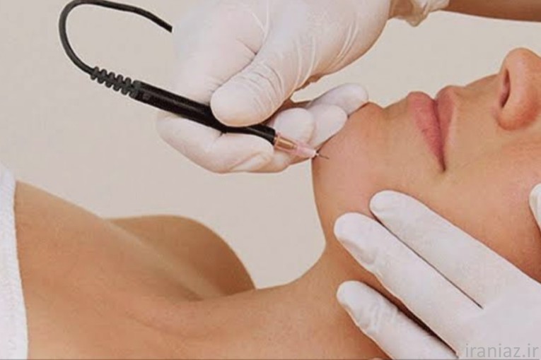 الکترولیز موهای سفید و کرکی 