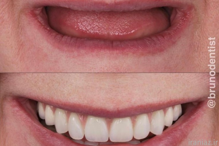 ساخت دندان مصنوعی(پروتز کامل دندان)