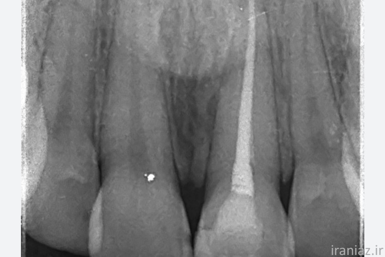 دندان مصنوعی و عصب کشی  با متخصص رایگان