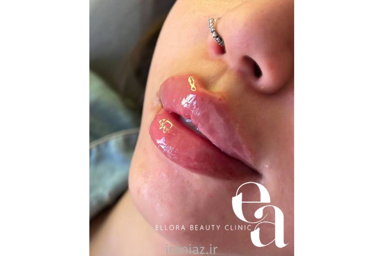  کلینیک زیبایی الورا ژل لب فیلر چانه