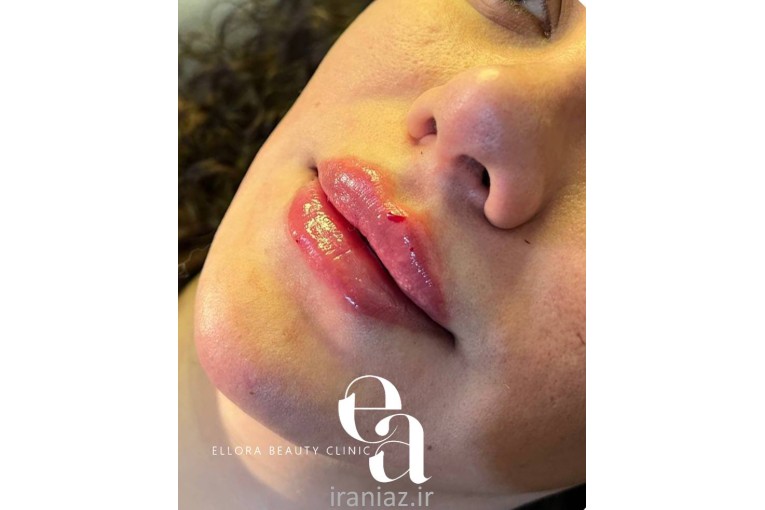  کلینیک زیبایی الورا ژل لب فیلر چانه