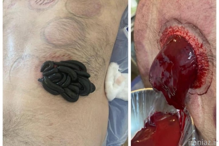 حجامت ‌فصدخون .زالودرمانی