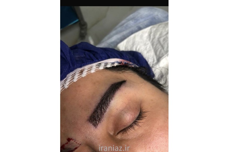 کاشت ابرو و مو