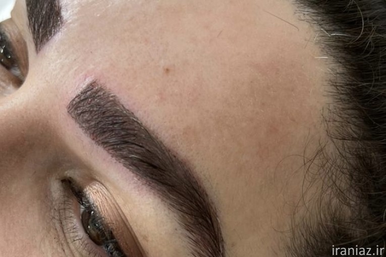 کاشت ابرو و مو