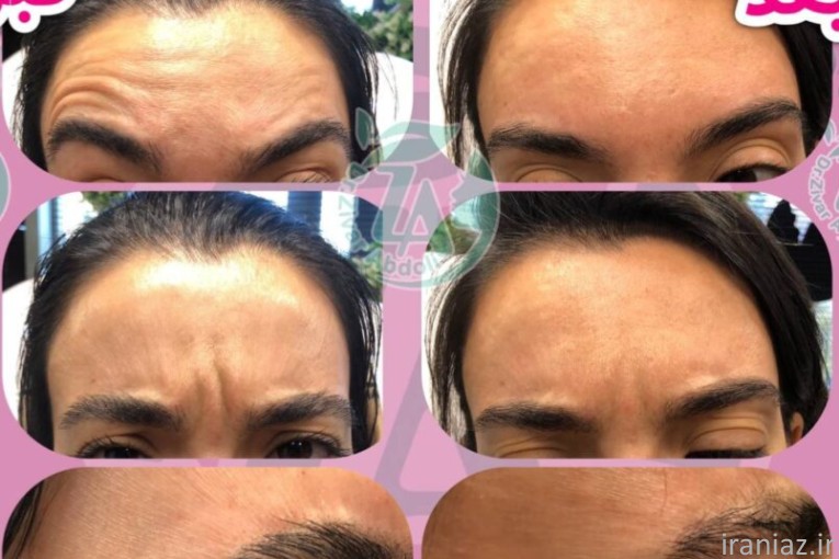 تزریق بوتاکس و ژل بسیار محدود