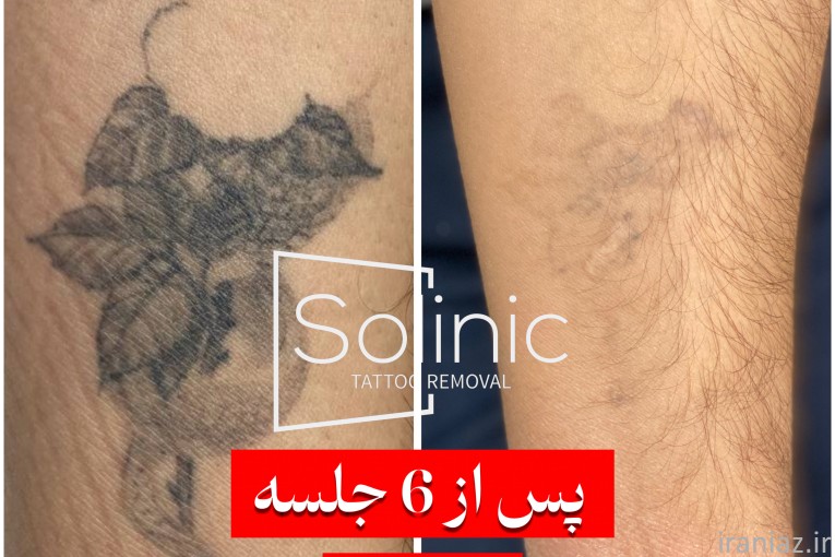 لیزر تتو ریمو تتو پاک کردن تتو