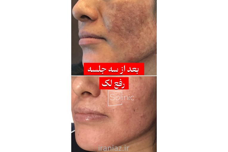 لیزر تتو ریمو تتو پاک کردن تتو