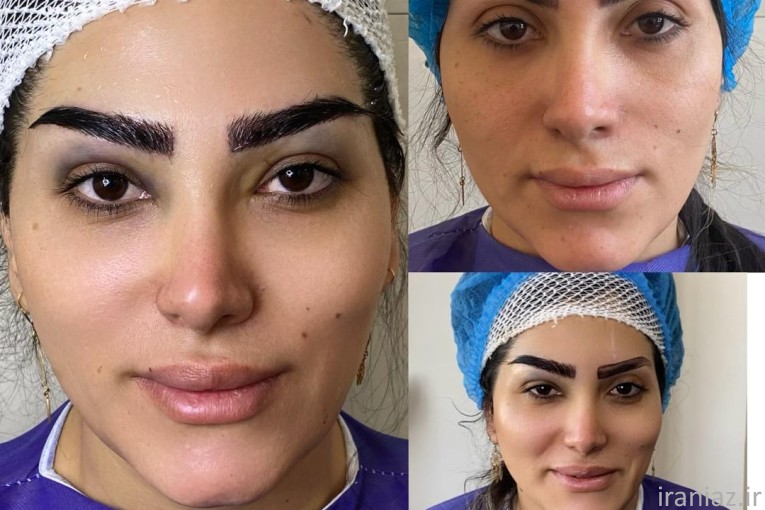 کاشت مو جوان 