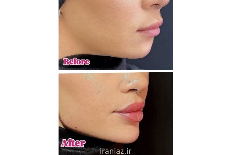 مدل رایگان ژل و بوتاکس