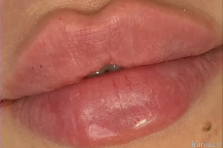 مدل رایگان ژل و بوتاکس