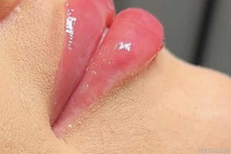 مدل رایگان ژل و بوتاکس