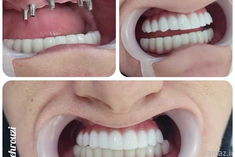 ایمپلنت دیجیتال / کاشت دندان