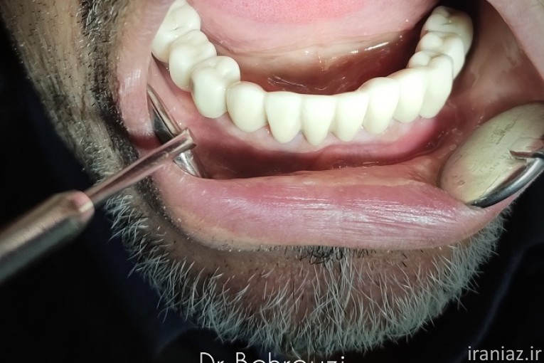 ایمپلنت دیجیتال / کاشت دندان