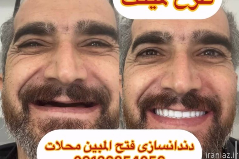 دندانسازی محلات
