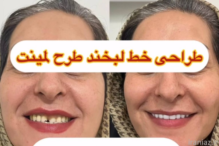 دندانسازی محلات