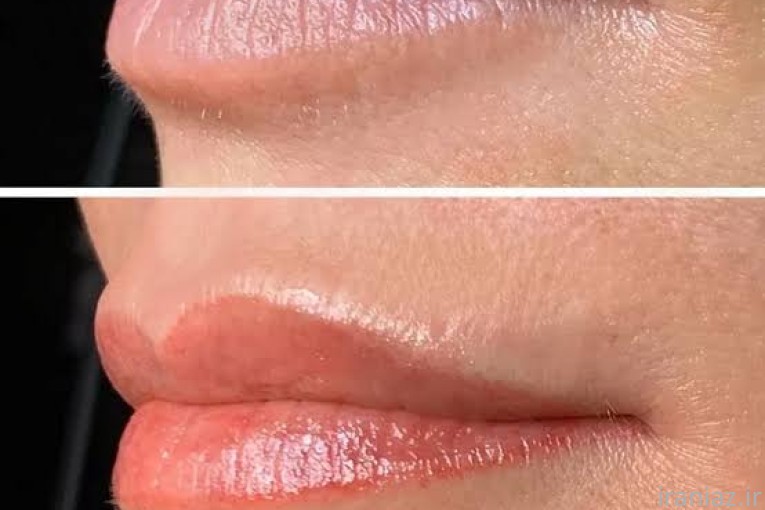 میکروبلیدینگ ابرو