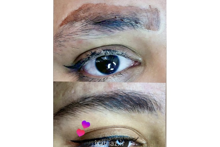 پاک کردن تاتو کرج_ ریمو تاتو کرج