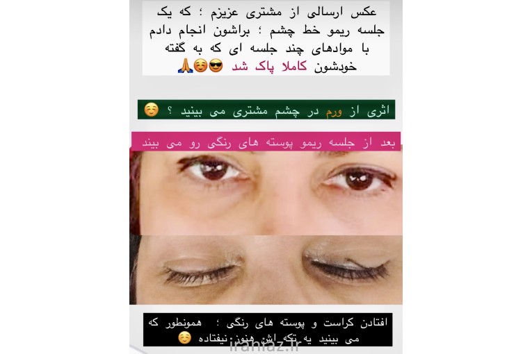 پاک کردن تاتو کرج_ ریمو تاتو کرج