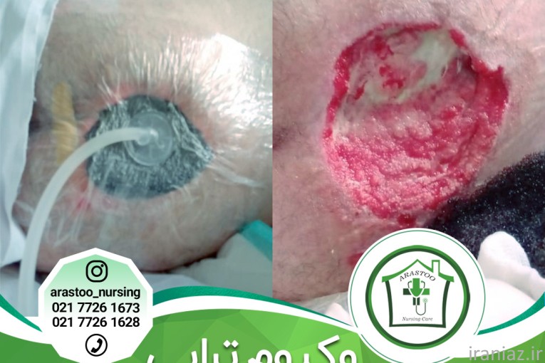 درمان زخم بستر در منزل