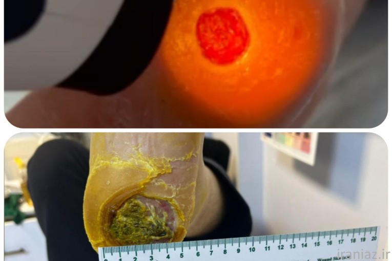 درمان زخم بستر در منزل