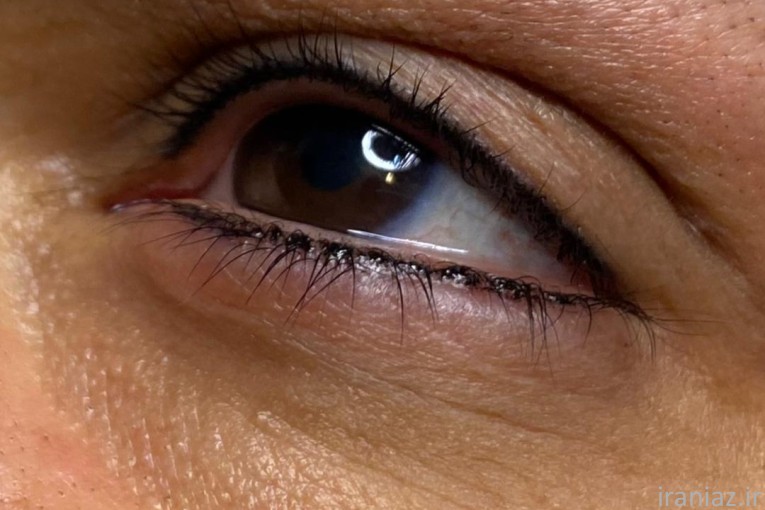  میکروپیگمنتیشن(مریم حمزه ای)