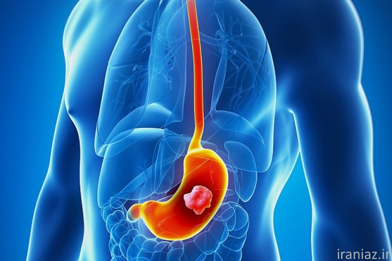 درمان مشکلات گوارشی تیکه چی معده 