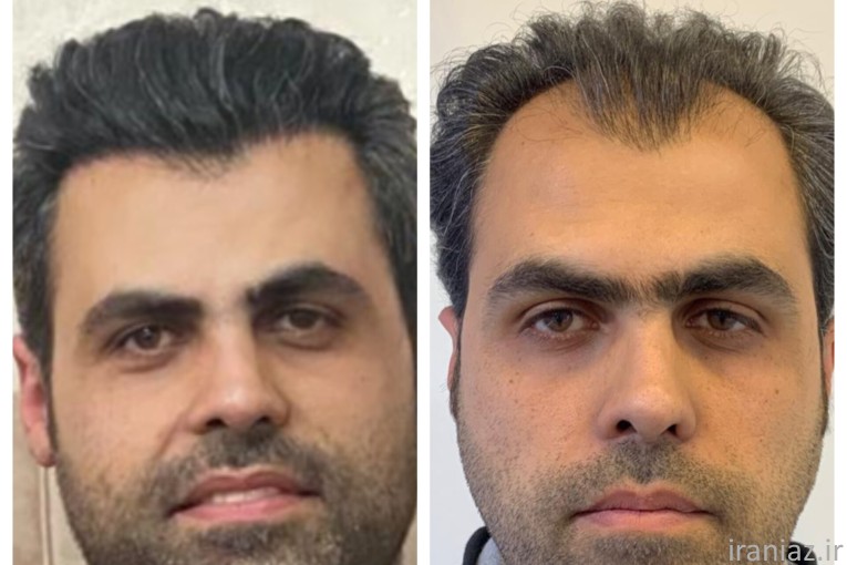 کاشت مو و ابرو تضمینی،۵۰ درصد تخفیف