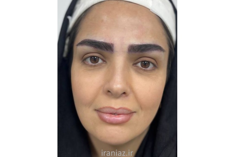 کاشت مو و ابرو تضمینی،۵۰ درصد تخفیف