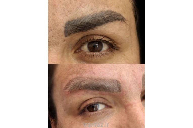 پاک کردن تتو با لیزر در بندرانزلی 