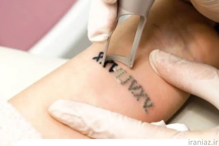 پاک کردن تتو با لیزر در بندرانزلی 