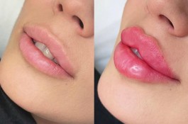 لیزر فیلر بوتاکس هایفو