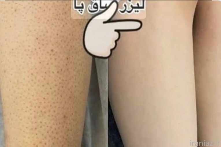 لیزر فیلر بوتاکس هایفو